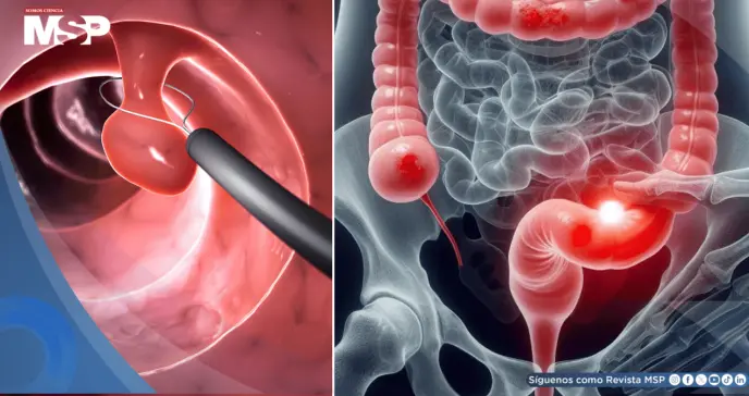 ¿Sangrado rectal? Podría ser señal temprana de cáncer colorrectal en adultos jóvenes