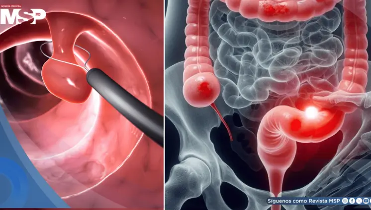 ¿Sangrado rectal? Podría ser señal temprana de cáncer colorrectal en adultos jóvenes ¿Sangrado rectal? Podría ser señal temprana de cáncer colorrectal en adultos jóvenes