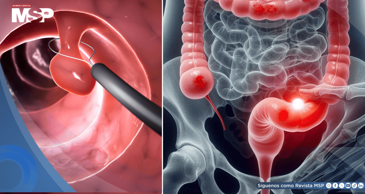 ¿Sangrado rectal? Podría ser señal temprana de cáncer colorrectal en adultos jóvenes