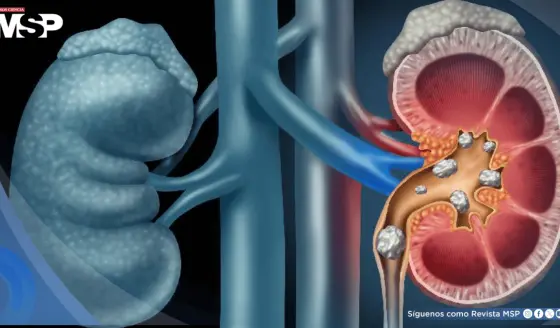 Trabajar de noche podría aumentar el riesgo de cálculos renales, advierte estudio
