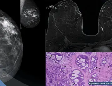 Cuatro mujeres desarrollan cáncer de mama multifocal justo donde colocaban el celular en el sostén
