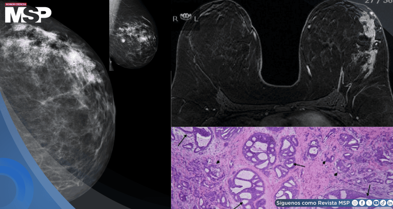 Cuatro mujeres desarrollan cáncer de mama multifocal justo donde colocaban el celular en el sostén