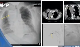 Hematoma mediastínico tras apendicectomía laparoscópica en paciente con enfermedad pulmonar intersticial
