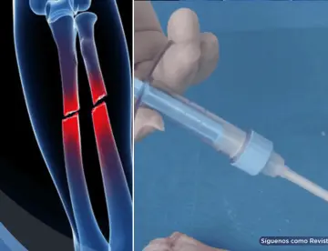 Desarrollan pegamento óseo que repara fracturas en tres minutos y podría reemplazar tornillos y placas
