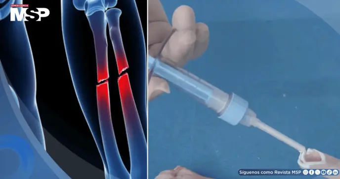 Desarrollan pegamento óseo que repara fracturas en tres minutos y podría reemplazar tornillos y placas