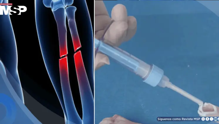 Desarrollan pegamento óseo que repara fracturas en tres minutos y podría reemplazar tornillos y placas Desarrollan pegamento óseo que repara fracturas en tres minutos y podría reemplazar tornillos y placas