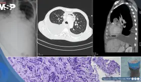 Hombre desarrolla infección cardíaca tras absceso dental drenado: Acumulación de pus comprimía su corazón