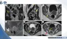 Cojera y dolor en la pierna izquierda revela diagnóstico de endometriosis del nervio ciático