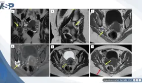 Cojera y dolor en la pierna izquierda revela diagnóstico de endometriosis del nervio ciático
