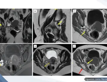 Cojera y dolor en la pierna izquierda revela diagnóstico de endometriosis del nervio ciático