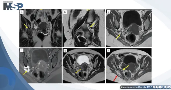 Cojera y dolor en la pierna izquierda revela diagnóstico de endometriosis del nervio ciático