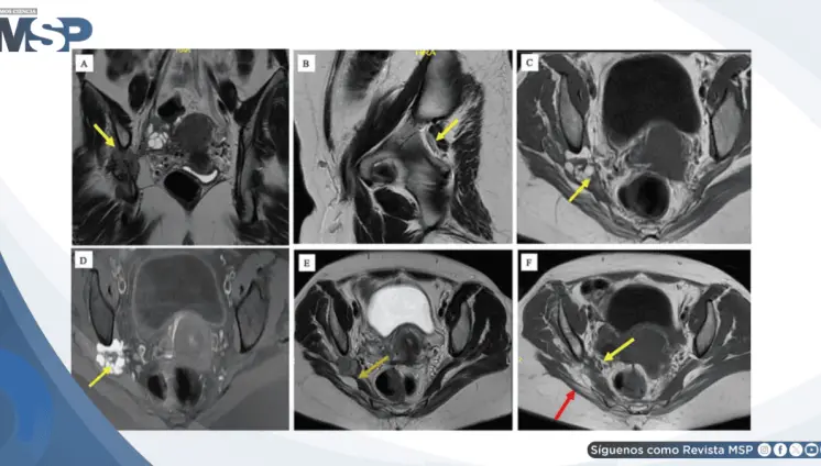 Cojera y dolor en la pierna izquierda revela diagnóstico de endometriosis del nervio ciático