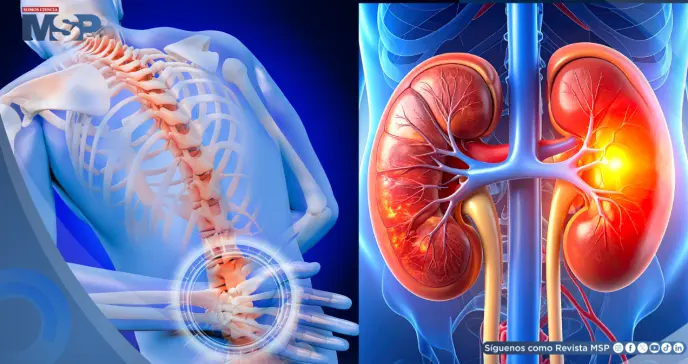 ¿Dolor de espalda o problema renal? Reconoce las señales que alertan sobre una afección en el riñón 