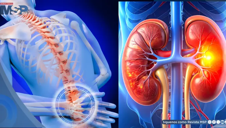 ¿Dolor de espalda o problema renal? Reconoce las señales que alertan sobre una afección en el riñón ¿Dolor de espalda o problema renal? Reconoce las señales que alertan sobre una afección en el riñón
