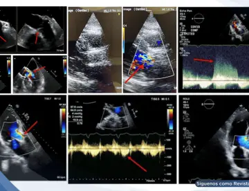 Fallo de reemplazo valvular transcatéter ocasiona trombosis aórtica secundaria a infección por COVID-19