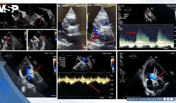 Fallo de reemplazo valvular transcatéter ocasiona trombosis aórtica secundaria a infección por COVID-19