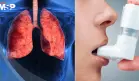 Inhaladores para el asma y la EPOC emiten más de 2 millones de toneladas de CO2 al año: Estudio 