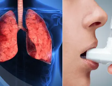 Inhaladores para el asma y la EPOC emiten más de 2 millones de toneladas de CO2 al año: Estudio 