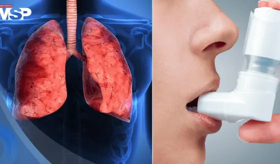 Inhaladores para el asma y la EPOC emiten más de 2 millones de toneladas de CO2 al año: Estudio 
