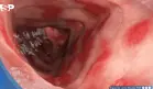 FDA aprueba primer tratamiento para colitis ulcerosa en niños que logra remisión del 32% en estudios