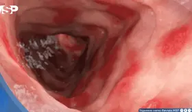 FDA aprueba primer tratamiento para colitis ulcerosa en niños que logra remisión del 32% en estudios