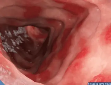 FDA aprueba primer tratamiento para colitis ulcerosa en niños que logra remisión del 32% en estudios