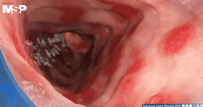 FDA aprueba primer tratamiento para colitis ulcerosa en niños que logra remisión del 32% en estudios