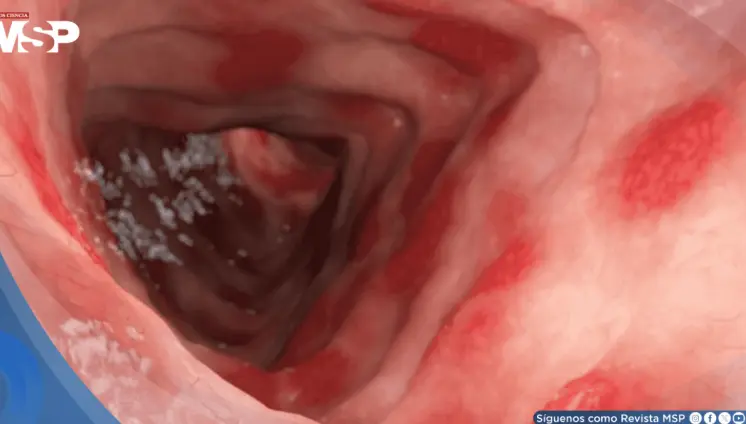 FDA aprueba primer tratamiento para colitis ulcerosa en niños que logra remisión del 32% en estudios FDA aprueba primer tratamiento para colitis ulcerosa en niños que logra remisión del 32% en estudios