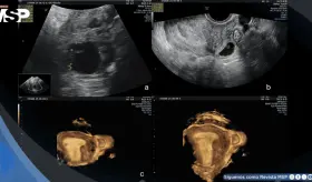 Embarazo intersticial tras transferencia de embriones congelados en paciente con salpingectomía bilateral