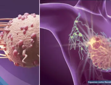 Alerta por aumento de cáncer de mama lobulillar: Crece tres veces más rápido que otros tipos en EE.UU