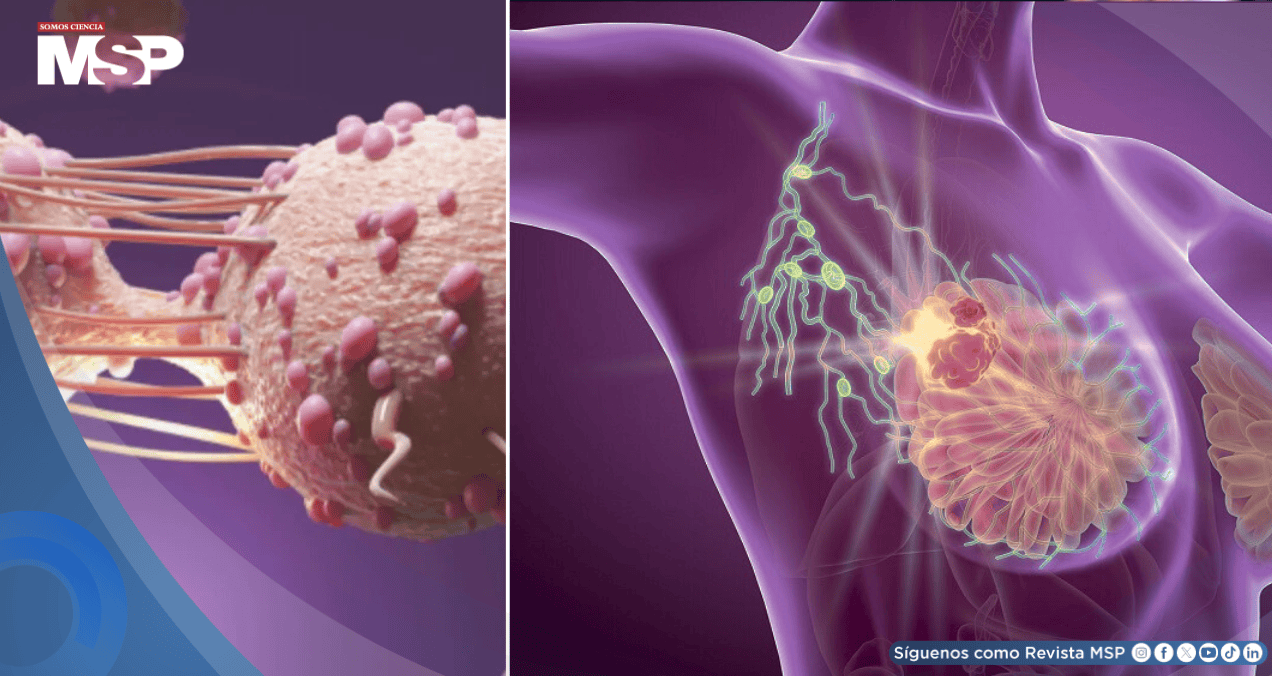 Alerta por aumento de cáncer de mama lobulillar: Crece tres veces más rápido que otros tipos en EE.UU
