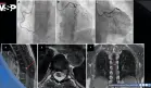 Dolor torácico persistente sin obstrucción coronaria resulta en schwannoma espinal torácico compresivo