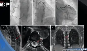 Dolor torácico persistente sin obstrucción coronaria resulta en schwannoma espinal torácico compresivo