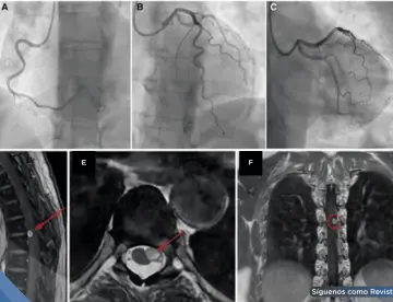 Dolor torácico persistente sin obstrucción coronaria resulta en schwannoma espinal torácico compresivo