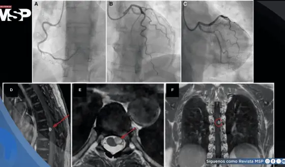Dolor torácico persistente sin obstrucción coronaria resulta en schwannoma espinal torácico compresivo
