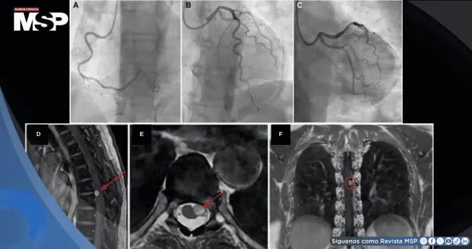 Dolor torácico persistente sin obstrucción coronaria resulta en schwannoma espinal torácico compresivo