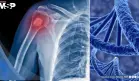 Identifican un nuevo gen que eleva el riesgo de osteosarcoma, el cáncer óseo más común en niños