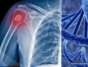 Identifican un nuevo gen que eleva el riesgo de osteosarcoma, el cáncer óseo más común en niños