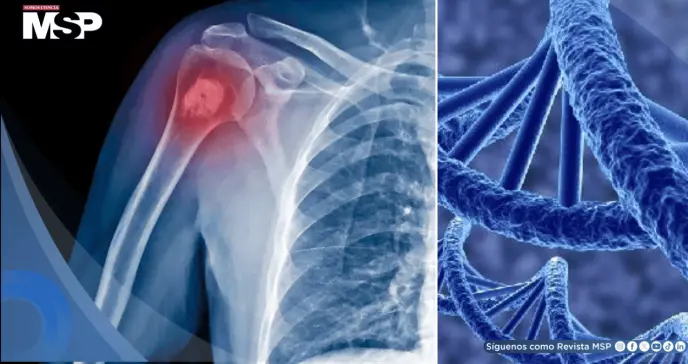 Identifican un nuevo gen que eleva el riesgo de osteosarcoma, el cáncer óseo más común en niños