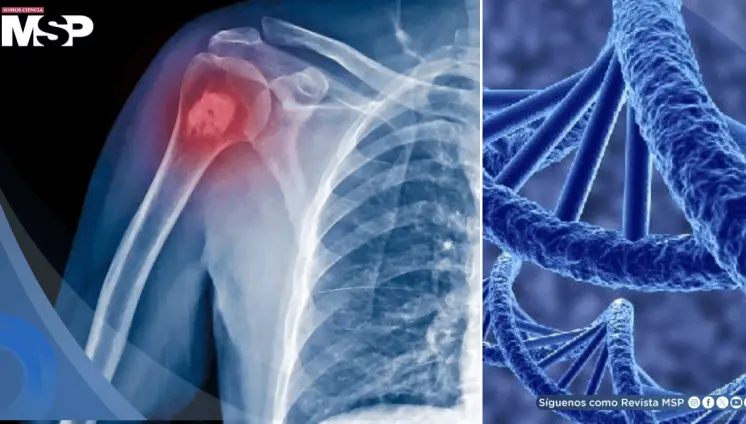 Identifican un nuevo gen que eleva el riesgo de osteosarcoma, el cáncer óseo más común en niños