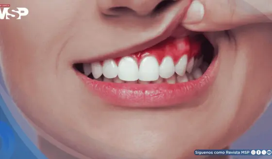 ¿Enrojecimiento e hinchazón en las encías? Todo lo que debe saber sobre la gingivitis