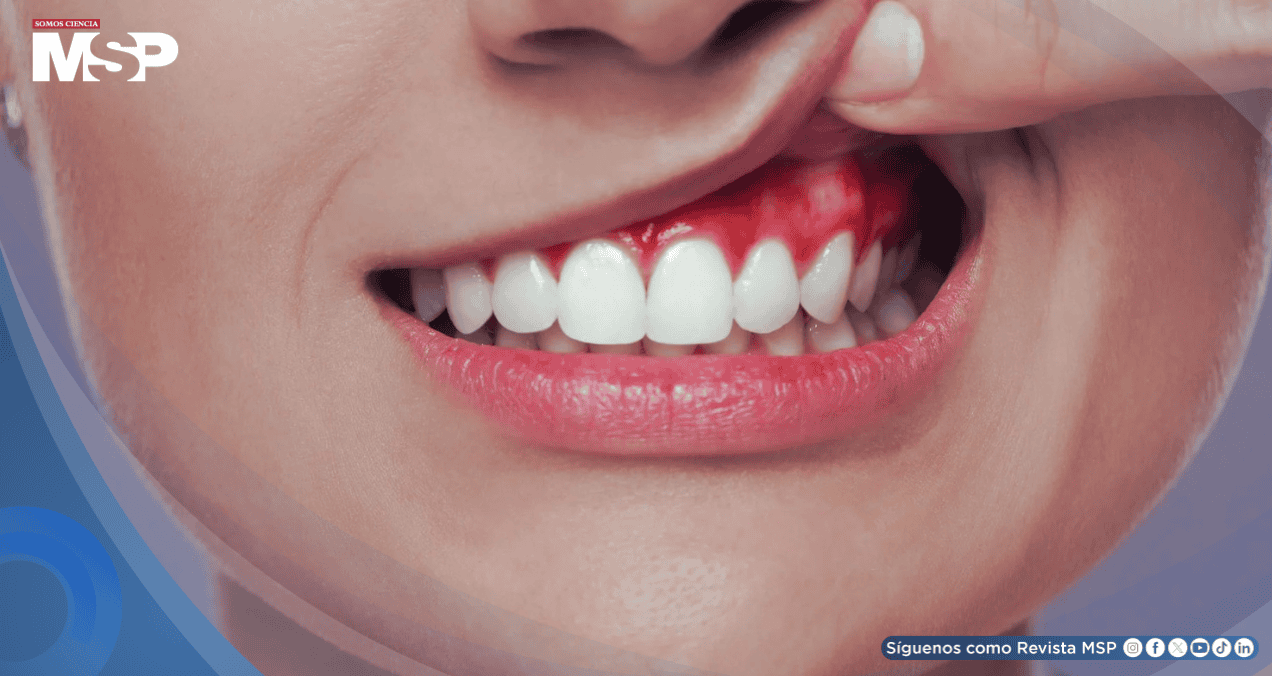 ¿Enrojecimiento e hinchazón en las encías? Todo lo que debe saber sobre la gingivitis