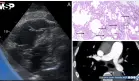 Shock obstructivo agudo por microangiopatía trombótica tumoral pulmonar en paciente con estenosis aórtica