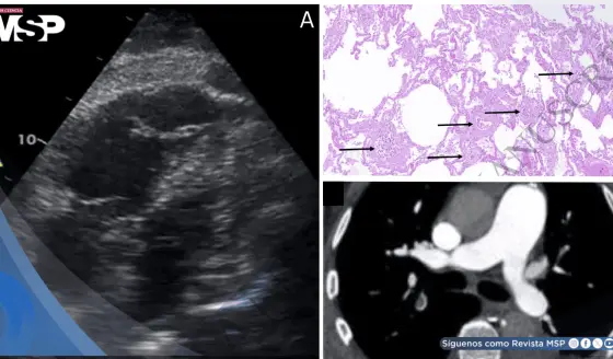 Shock obstructivo agudo por microangiopatía trombótica tumoral pulmonar en paciente con estenosis aórtica