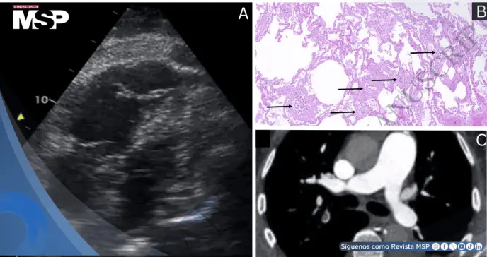 Shock obstructivo agudo por microangiopatía trombótica tumoral pulmonar en paciente con estenosis aórtica