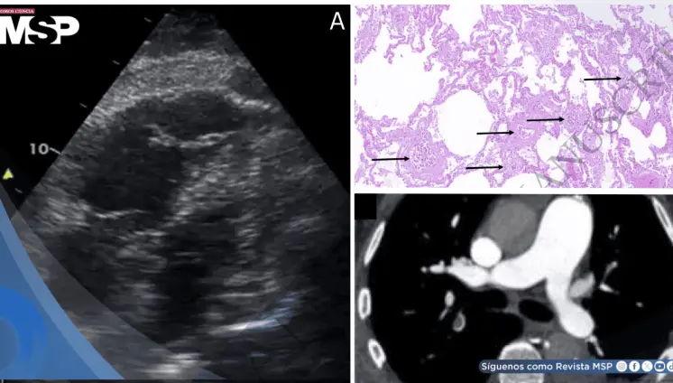 Shock obstructivo agudo por microangiopatía trombótica tumoral pulmonar en paciente con estenosis aórtica