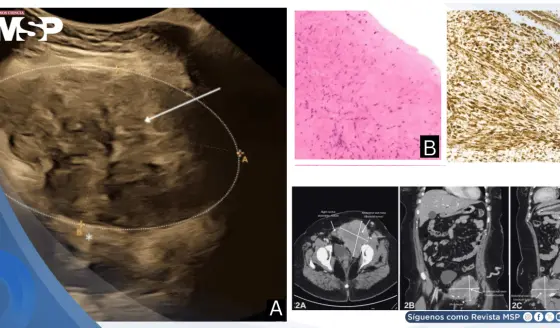 Tumor desmoide abdominal de compresión ilíaca durante el embarazo causa trombosis venosa profunda crónica