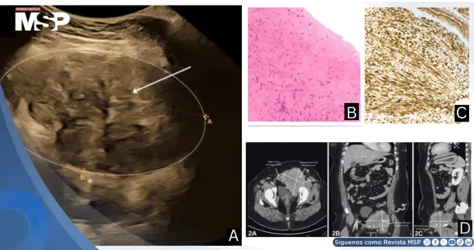 Tumor desmoide abdominal de compresión ilíaca durante el embarazo causa trombosis venosa profunda crónica
