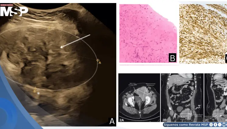 Tumor desmoide abdominal de compresión ilíaca durante el embarazo causa trombosis venosa profunda crónica