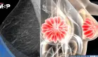 Descubren que la densidad mamaria podría dificultar la detección del cáncer de mama 
